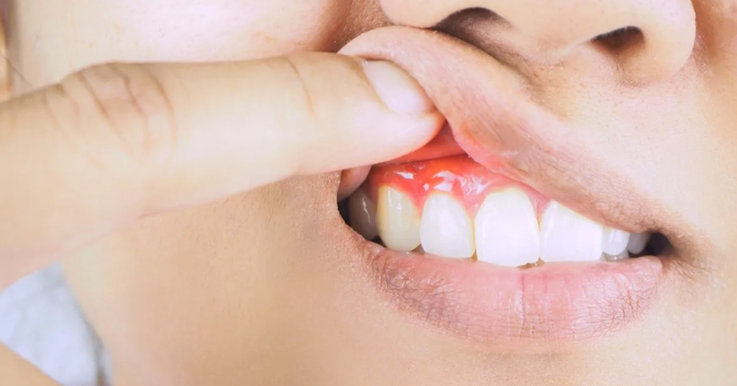 What Causes Gum Disease