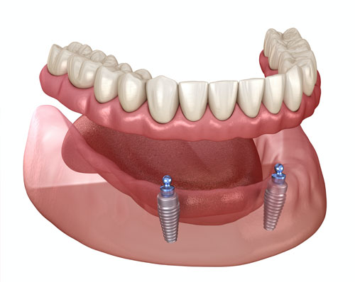 Full or Partial Dentures